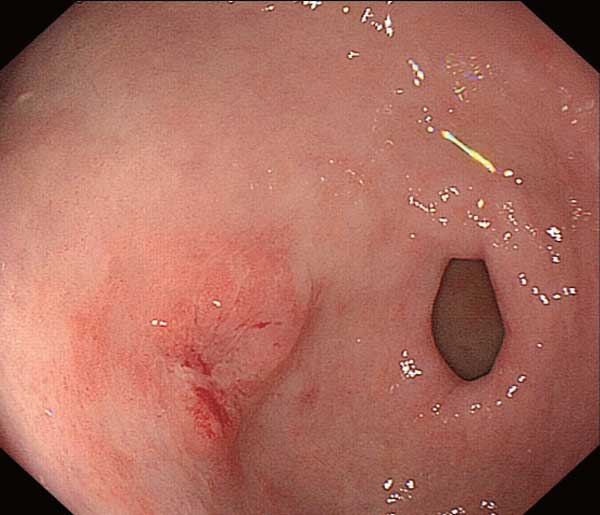 輕型淺表型慢性胃炎