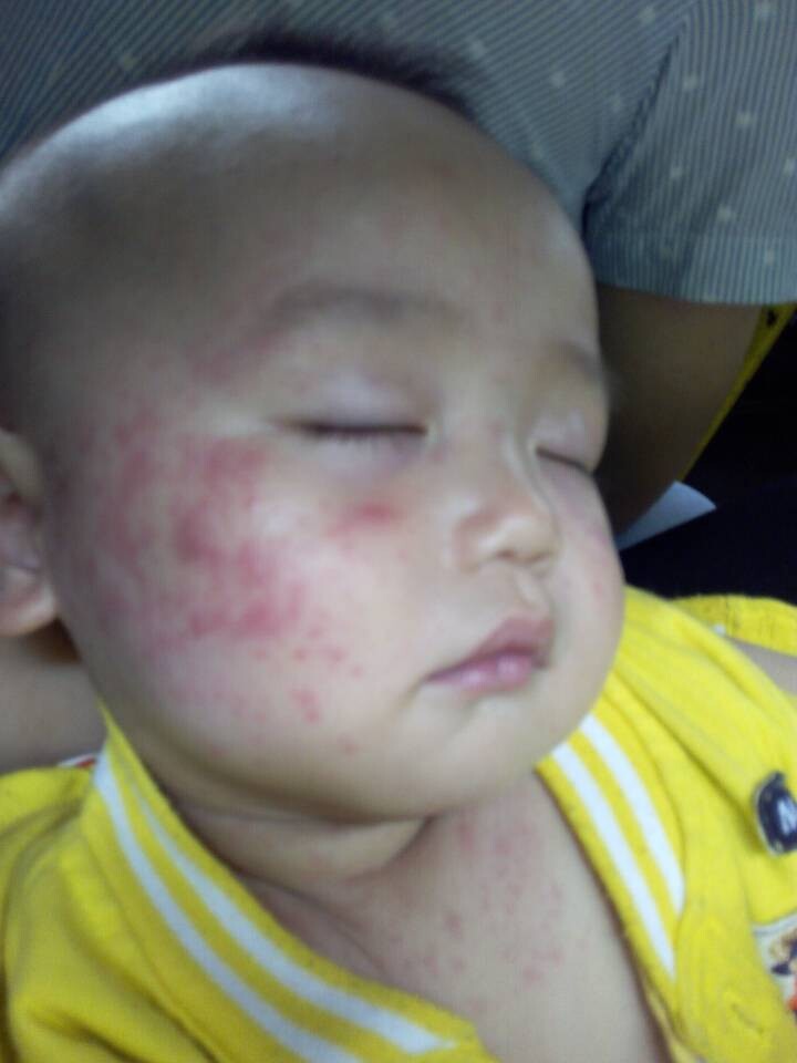 小兒急疹的症狀 (8) 