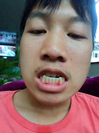 牙齦炎和牙周炎