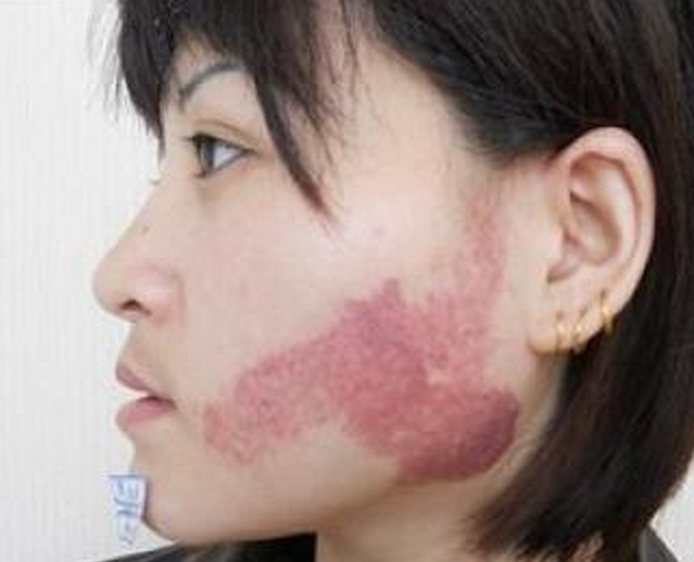 面部鮮紅斑痣