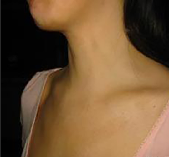 亞急性甲狀腺炎的