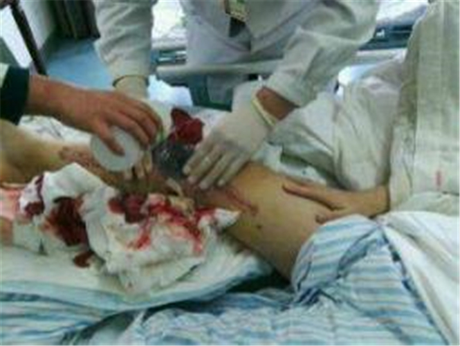 右腿骨肉瘤護理