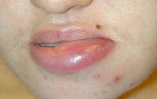 嘴上長皰疹 (46) 