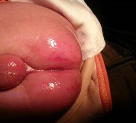 寶寶紅屁屁照片 (50) 