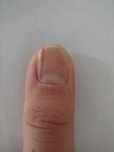 手指甲上有豎紋圖解 (43) 