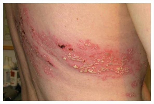 帶狀皰疹樣外觀