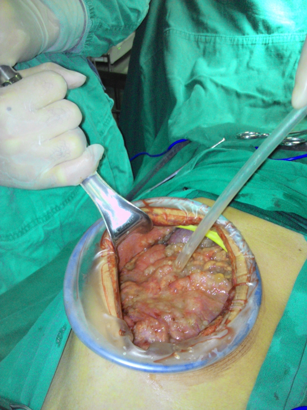 腫瘤腸腫瘤病變真