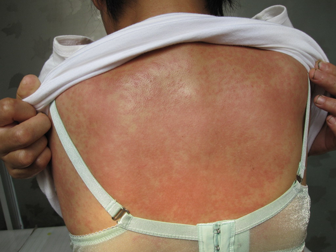 背部接觸性皮炎