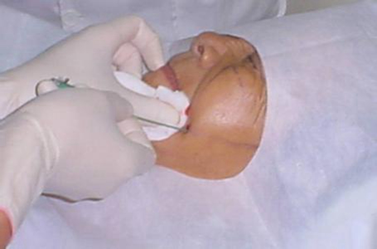 治療原發性三叉神經痛病例