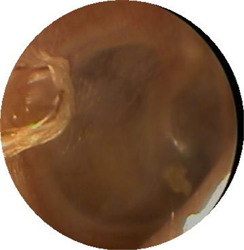 治療的鼓膜穿孔