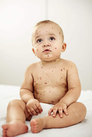 長水痘的症狀 (57) 