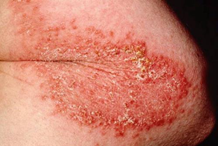 過敏接觸性皮炎症狀