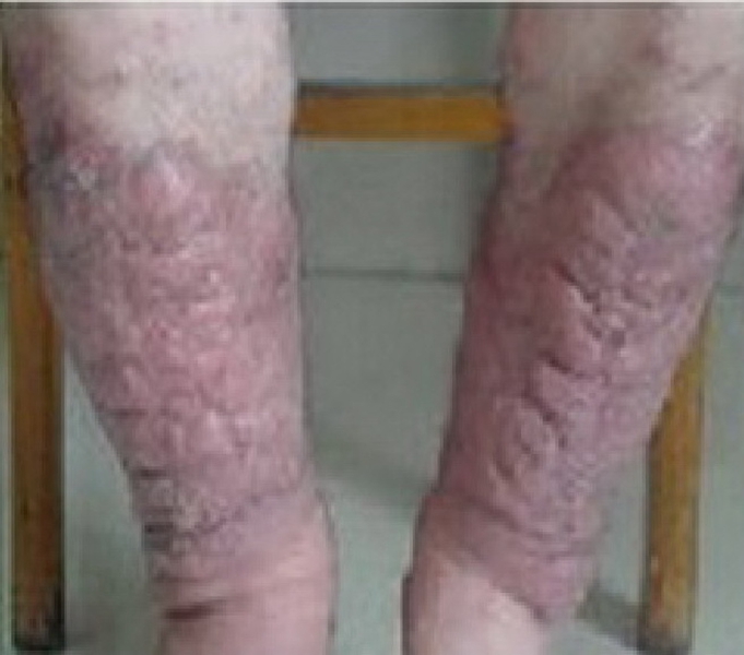 嚴重皮膚黃色瘤病的