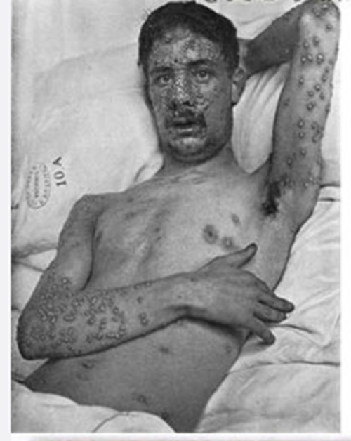 天花有什麼症狀