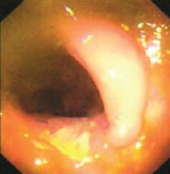 克羅恩病小腸的鏡下