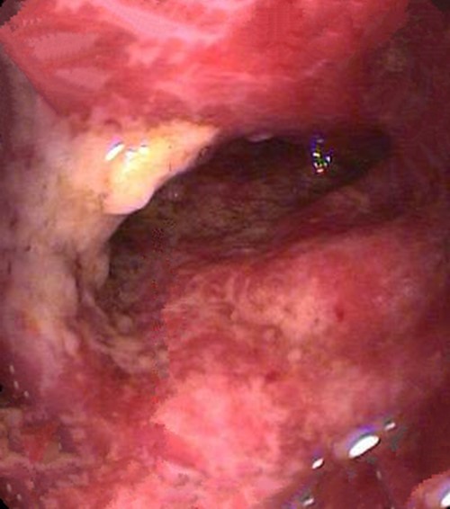 什麼導致慢性結腸炎的