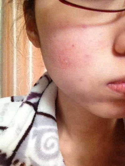 急性皮炎的症狀