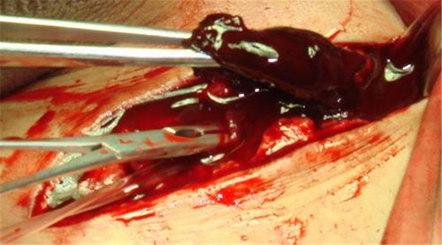 手術治療腦血栓