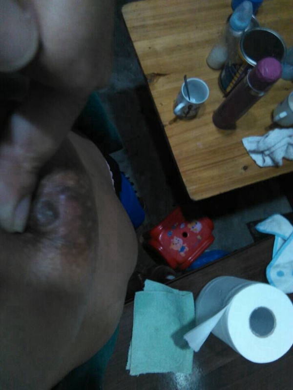 乳腺癌乳頭內陷