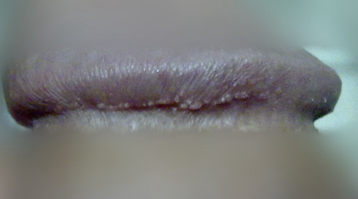 男性尖銳溼疣照片 (8) 