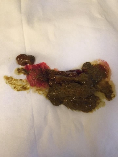 直腸癌晚期症狀 (53) 