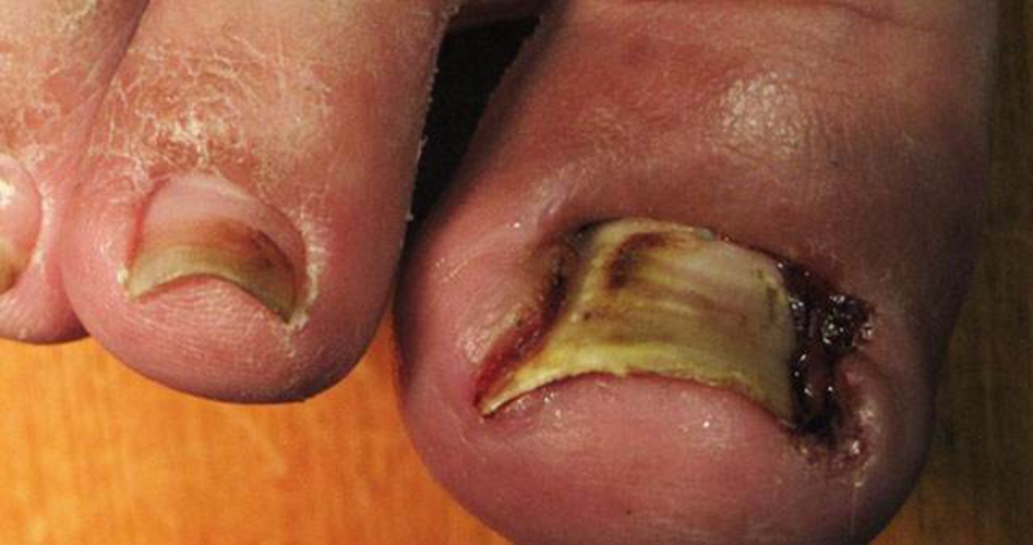 碘酊可以治甲周炎嗎