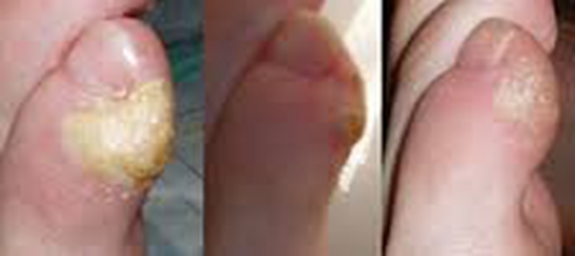 胼胝體發育不良的