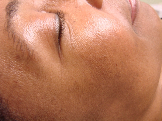 皮膚纖維瘤 (48) 