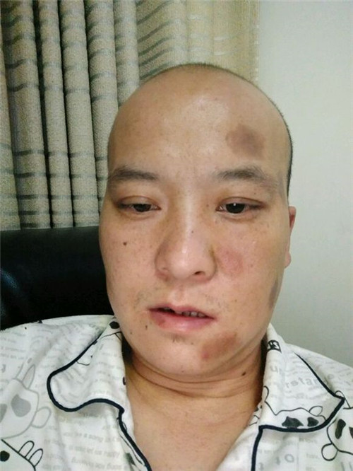 治療面癱恢復的