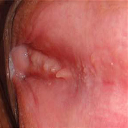 局部外陰瘙癢的