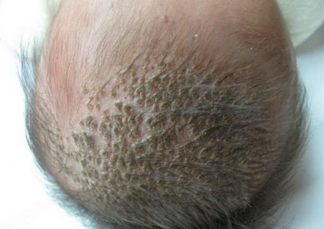 頭癬的症狀