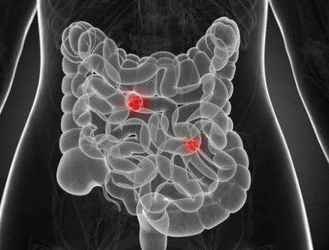 闌尾炎的症狀表現 (50) 