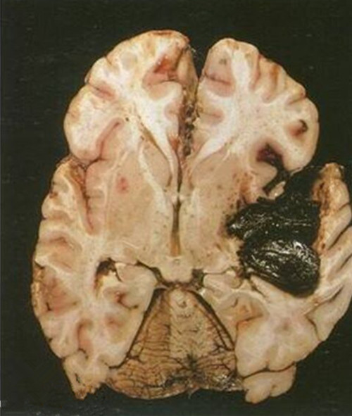 細菌性腦膜炎的解剖