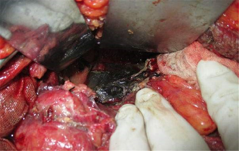 重症急性胰腺炎治療