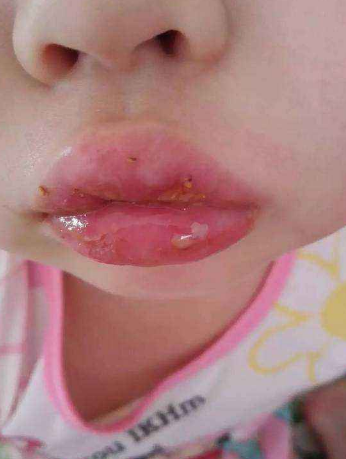嘴唇潰瘍