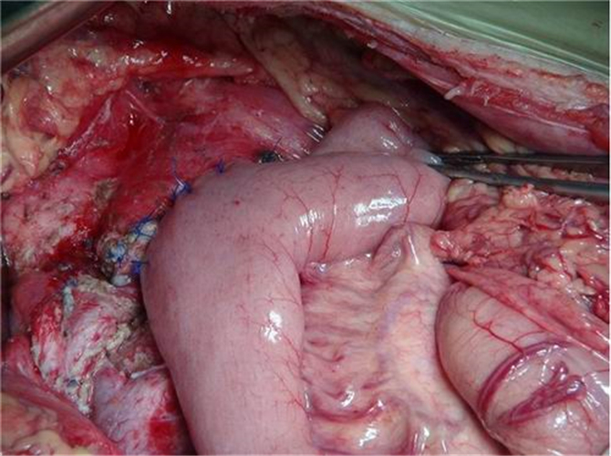 手術治療急性胰腺炎