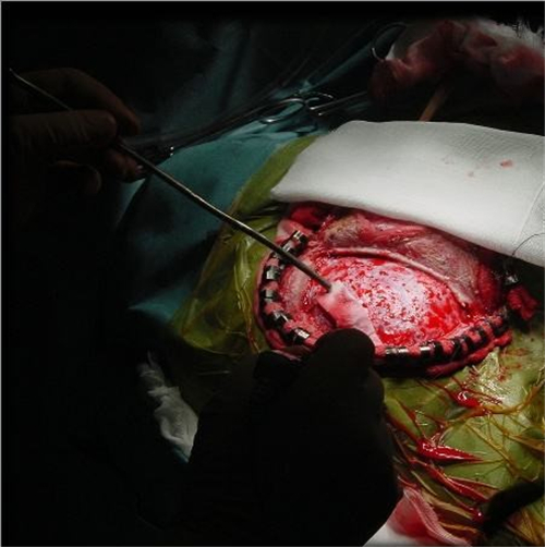 煙霧病引發腦血管痙攣治療