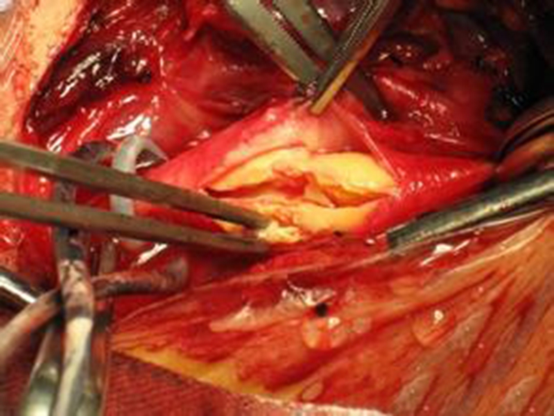 幼兒煙霧病腦手術