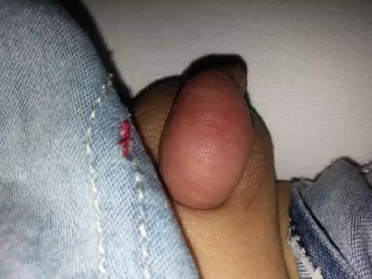 黴菌性龜頭炎 (5) 