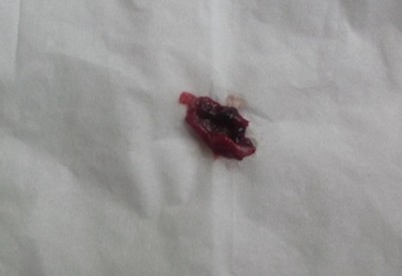 流產掉下來的孕囊