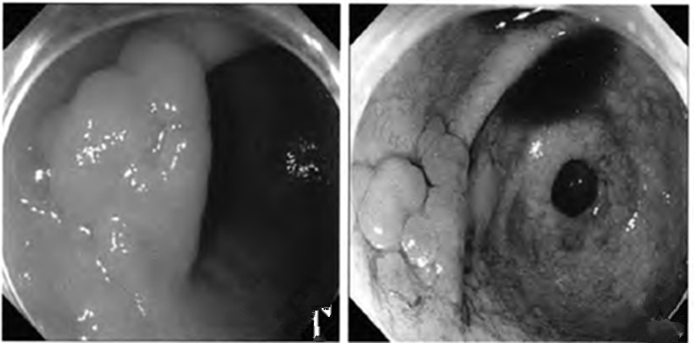 萎縮淺表性慢性胃炎