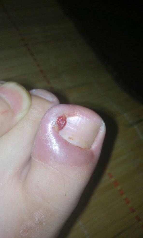 腳趾頭是甲周炎的