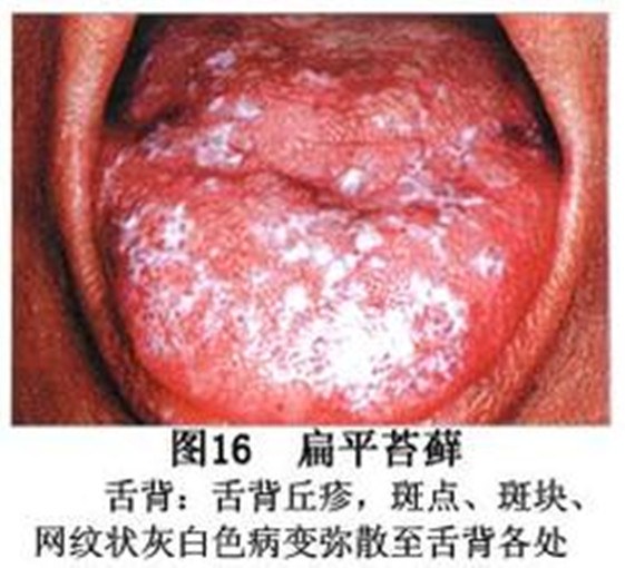 治療口腔扁平苔蘚偏方 