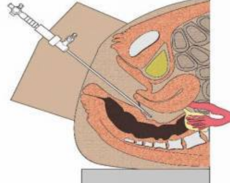治療中人工陰道的