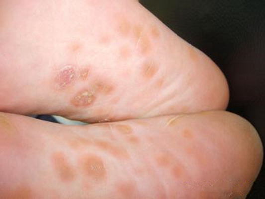 艾滋病紅疹症狀