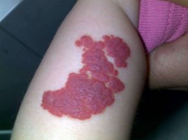 鮮紅斑痣血管瘤