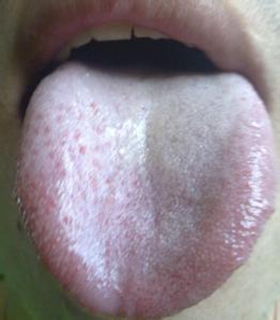 口腔念珠菌感染 (38) 