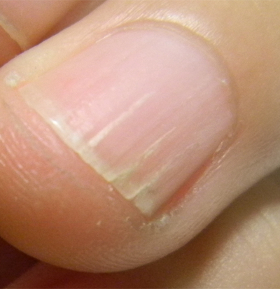 手指甲上有豎紋圖解 (42) 