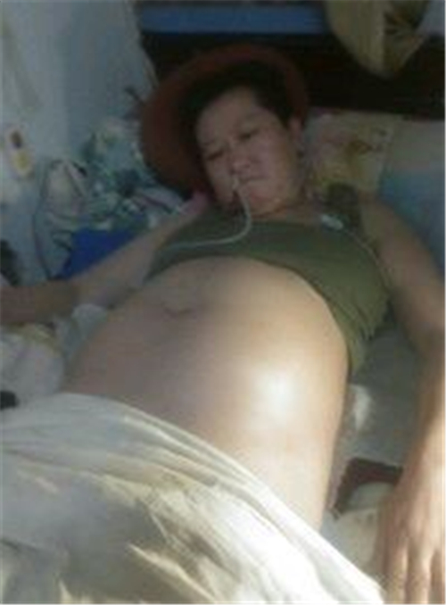 男性急性胰腺炎症狀