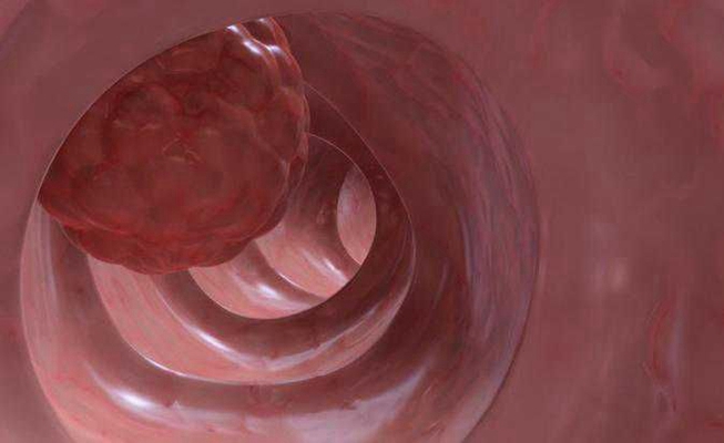 直腸癌晚期症狀 (39) 